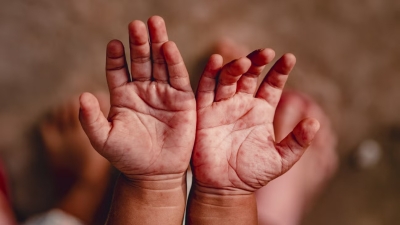 Rise in Hand, Foot and Mouth Disease Cases Reported in Preschools