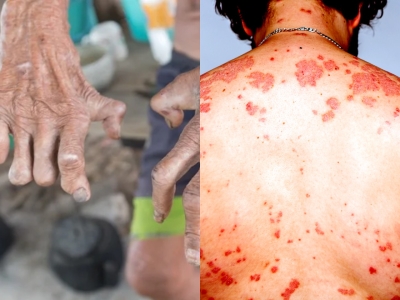 Leprosy on the Rise; HIV on the Decline On-Island